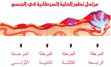 مراحل تطور الخلية السرطانية في الجسم