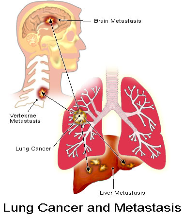 سرطان الرئة
