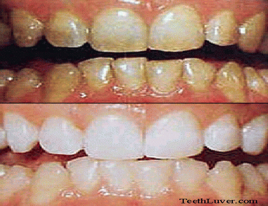 أسنان صفراء، وأسنان بيضاء